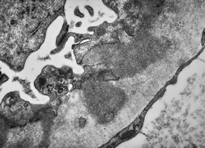 F,74y. | membranous glomerulopathy F,74y. | membranous glomerulopathy